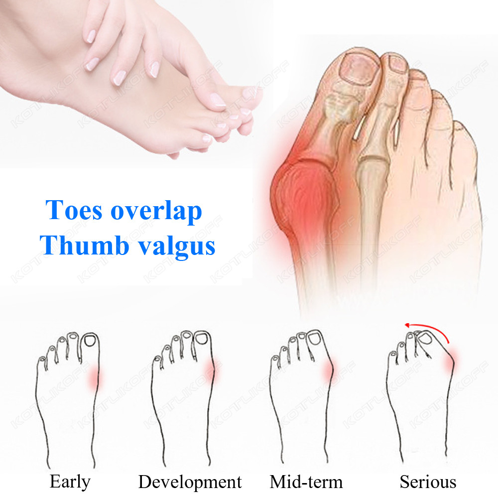 Защитный разделитель пальцев н – обзор и цена Toe Separator Silicon